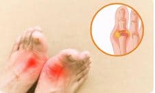 痛风是吃出来的吗?